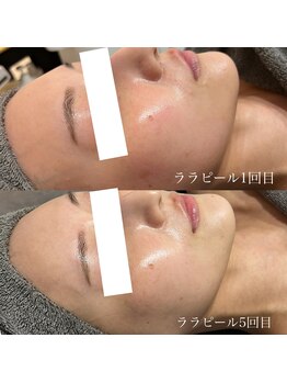 ナーズ(NAZ)/ララピール