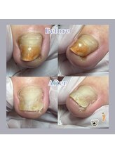 巻き爪補正店 天王寺店/巻き爪の影響で変形したお爪