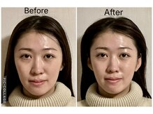 ショウフェイスデザイン(Sho Face Design)/《小顔矯正》ビフォーアフター