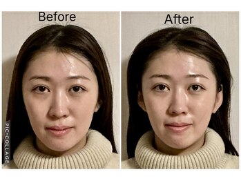 ショウフェイスデザイン(Sho Face Design)/《小顔矯正》ビフォーアフター