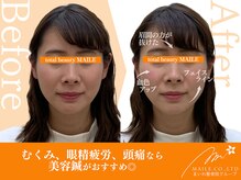 まいれ鍼灸院整骨院 整体院 大津市膳所院/美容鍼（20代女性/施術1回目）