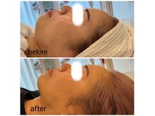 ルブラン セルラム コウベ(LeBLANC CELLULAM KOBE)の雰囲気（<セルラム>ダウンタイム無し!くすみ/黒ずみにも効果◎敏感肌も◎）