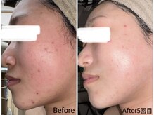 ミニョン(mignon)