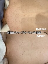 ブロッサム(Blossom)/剥離ありハーブピーリング背中
