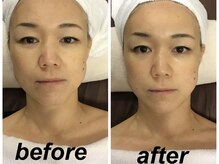 ラウレア(LAULEA)/【ラジオ波】小顔・コリに効果◎