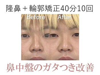 ラプリ 大阪心斎橋店(Raplit)/隆鼻＋輪郭矯正40分10回