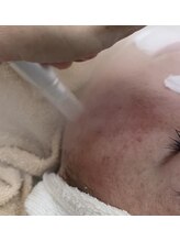 モスト(MOST)/毛穴洗浄