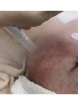 モスト(MOST)/毛穴洗浄