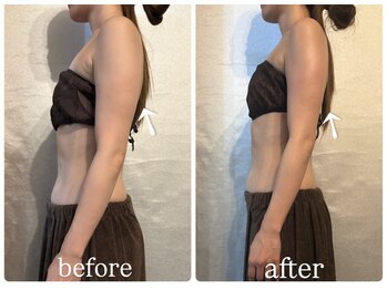 ビノスビューティー(vinos.beauty)/症例写真　上半身痩身