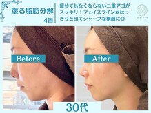 フローフシ∞/【小顔】塗る脂肪分解&燃焼