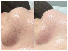 トータルビューティ ノイド(Noid)/毛穴洗浄　いちご鼻撃退