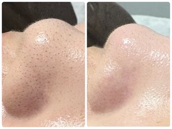 トータルビューティ ノイド(Noid)/毛穴洗浄　いちご鼻撃退