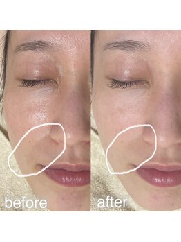 アルム(a'lm)/ほうれい線へもハリアプローチ♪