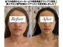 フェミニー(Feminy)/【小顔整顔リフト】別人級