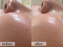 エステサロン ジョアアンジェ(joie ange)/ララピール　1回