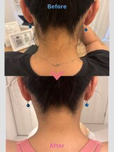 フィズ 国分寺店(FIS)/うなじ脱毛