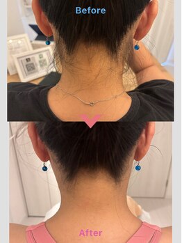 フィズ 国分寺店(FIS)/うなじ脱毛