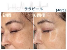 美シェリ(美Cheri)の雰囲気(大人女性の肌管理。感動のハリツヤ実感!次世代ピーリング)