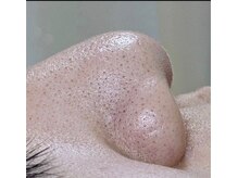 美プラス/《20代》最新毛穴洗浄