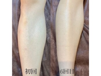 サロン ルーシュ(salon ruche)/脱毛(ひざ下)