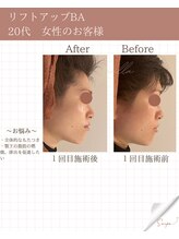 ミーカラー(mecalla.)/リフトアップBA