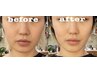 【お悩み別】メンズ利用OK!光美肌フォトRF+白玉ホイップパックor保湿パック