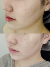 ビーユー(Be.you)/毛穴洗浄＆小顔