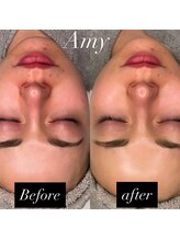 エイミー(Amy)/-【乳酸/ピーリング】-