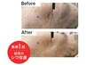 結果出し最高峰★エクソソーム×幹細胞培養液導入◎シミ/しわ/たるみ◎¥7800