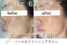 パールホワイトニング