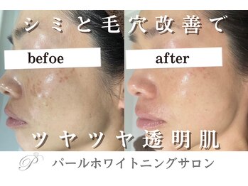 パールホワイトニング