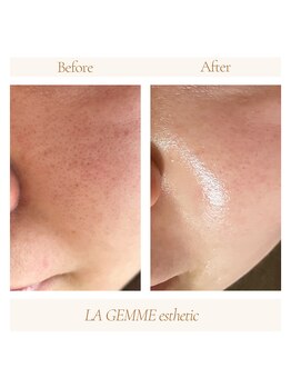 ラジェム(LA GEMME)/人気の「水素ハイドロ＋フォト」