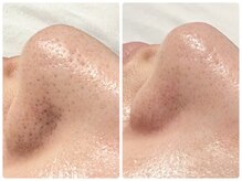 トータルビューティ ノイド(Noid)/毛穴洗浄　いちご鼻撃退