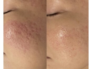 ブブオム 恵比寿本店(BUB OMME)/サーマトリックス