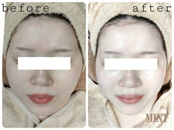 ミント 武蔵小杉店(MINT)/凹凸ケアならサーマトリックス