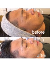 ナナラ(nanala)/メンズフェイシャル