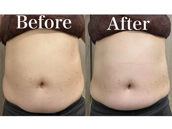 モリタ鍼灸整骨院/【ラジオ波】ボディメイク