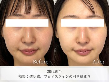 アストリエ グレース 相模大野(Astorie Grace)/1回でもリフトアップ♪