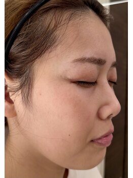 ラシェプリズ(LACHER PRISE)/施術経過（30代）