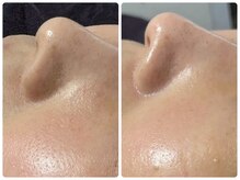 トータルビューティ ノイド(Noid)/毛穴洗浄　全顔フル