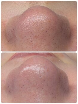 ワイズ(Y's)/毛穴黒ずみ・角栓吸引