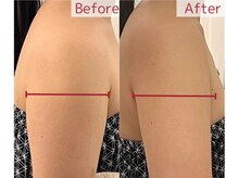 脱毛 痩身ぴゅあら/気になる二の腕すっきり！！