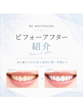 ビーホワイト 名古屋金山店(BE WHITE)/ホワイトニングビフォーアフター