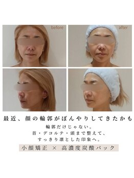 カフー(kafuu)の写真/美しいフェイスラインは日々の積み重ねから。エラ張り・左右差を整え、中顔面短縮でバランスの整った小顔へ