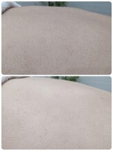 エステシェービングサロン フルール(Fleur)/背中のシェービング