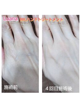 ルアナ(Luana)/BBLハンドトリートメントの効果