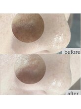 ダリアビューティー(Dahlia Beauty)/角栓の詰まりを除去したい！