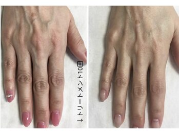 エムフルール(M fleur)/ハンドエステ ビフォアフ