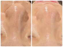 トータルビューティ ノイド(Noid)/毛穴洗浄　全顔フル