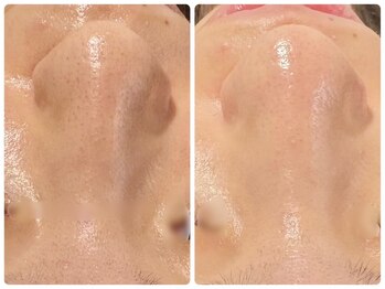 トータルビューティ ノイド(Noid)/毛穴洗浄　全顔フル